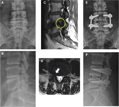 Indirect decompression via oblique lumbar interbody fusion is sufficient for treatment of lumbar foraminal stenosis